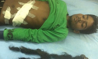 Phát hiện thai nhi trong người chàng trai Ấn Độ