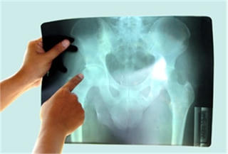 Đồng Nai: Phẫu thuật thành công thay chỏm xương bị hoại tử