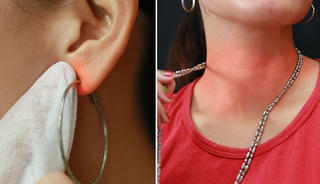 Vì sao bị dị ứng da do đeo trang sức kim loại?