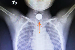 Cấp cứu kịp thời bé trai 5 tuổi hóc đồng xu ngày đầu năm mới