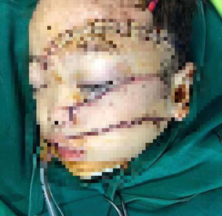 Đau lòng bố đẻ chém con trai 5 tuổi nguy kịch