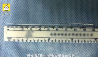 Kinh hãi sán dây dài 10 cm sống ký sinh trong não