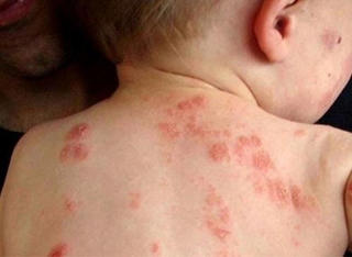 Phòng tránh các bệnh về da trong mùa hè nắng nóng