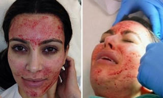 Các chiêu thức làm đẹp rùng rợn