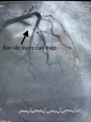 Một người dân ngưng tim, ngưng thở được cứu sống 