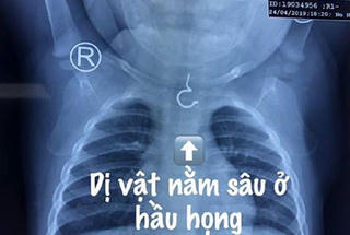 Bé gái 1 tuổi suýt gặp họa lớn khi giật khuyên tai bằng vàng của bạn để... nuốt