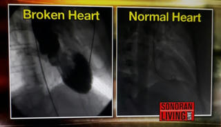 Hội chứng 'trái tim vỡ': Tổn thương tim do stress