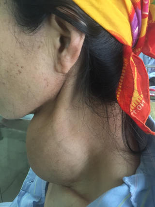 Phẫu thuật khối u khổng lồ tồn tại 15 năm trên bệnh nhân 76 tuổi