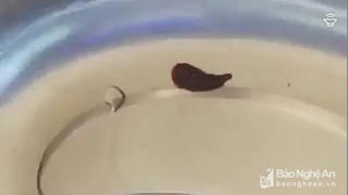 Phát hiện con vắt dài 5cm sống trong mũi bệnh nhân