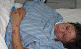 Bệnh nhân Hà Nội viêm não mô cầu, 27 người phải cách ly