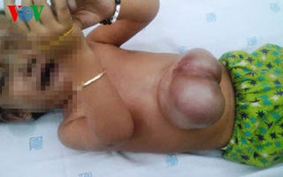 Bệnh nhi có tim ngoài lồng ngực đầu tiên được phẫu thuật thành công