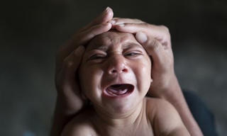 Mỹ: Xác định thai nhi đầu tiên dị tật đầu nhỏ liên quan tới Zika
