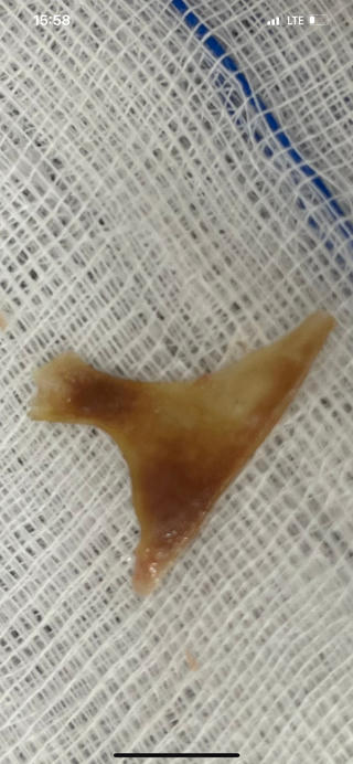 Cứu bà cụ gần 70 tuổi bị hóc xương heo 'khủng' chỉ với 10 phút 