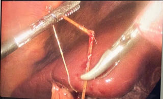 Bị đâm thủng đường tiêu hóa vì thói quen ngậm tăm khi ngủ