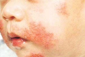 Hơn 1 tỉ người trên thế giới đang mắc bệnh dị ứng