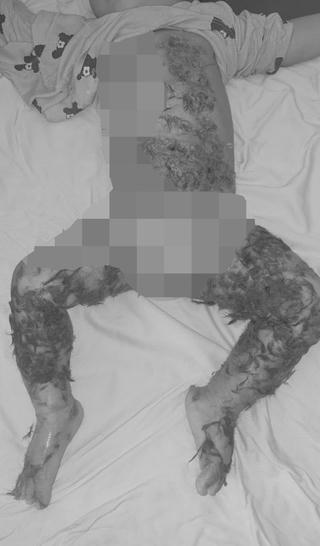 Thầy lang dùng lông chó đắp lên vết bỏng bé 8 tháng tuổi