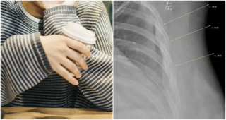 Nghiện cà phê, cô gái 30 tuổi có xương như cụ già