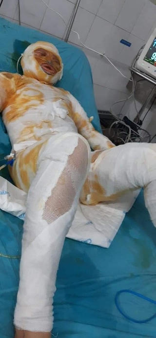 Thái Bình: Người vợ bị chồng tẩm xăng đốt đã tử vong