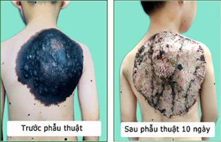 'Gỡ' mai rùa trên lưng cho cậu bé 7 tuổi