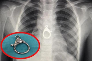 Gắp móc khóa trong vùng ngực bé trai 6 tuổi ra ngoài an toàn
