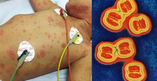 Đề phòng bệnh Viêm não mô cầu lan rộng