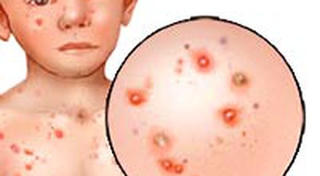 Cảnh giác bệnh thủy đậu