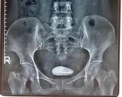 Dụng cụ tránh thai đi lạc trong ổ bụng cụ bà 65 tuổi