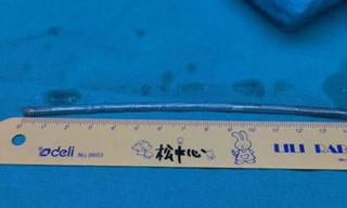 Tức giận vợ, người đàn ông nuốt trọn cây đinh dài 15 cm