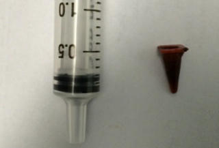 Đồ chơi mắc kẹt trong phổi suốt 40 năm