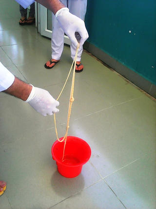 Xổ sán xơ mít dài 10 m trong người bệnh nhân