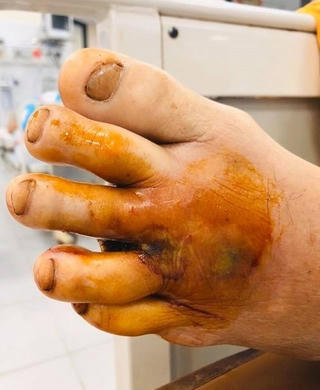 1 trường hợp mắc Whimore tại Hoà Bình