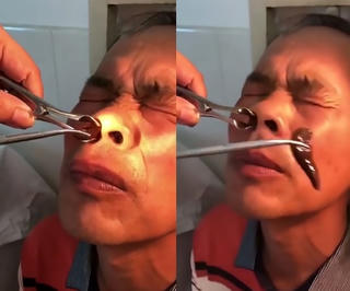 Đỉa sống suốt 2 tuần trong mũi người đàn ông