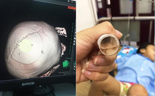 Vụ bé gái 3 tuổi có đinh găm ở đầu: Người thân cháu bé nói gì?