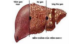 Virus viêm gan C - sát thủ thầm lặng