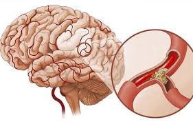 Sản xuất thành công chế phẩm làm thuốc phòng, chống tắc nghẽn mạch máu