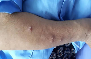 Bộ Y tế yêu cầu giám sát chặt bệnh Whitmore