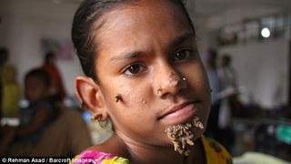 Kỳ lạ cô bé ‘người cây’ ở Bangladesh