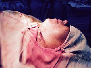 Quảng Nam: Cứu sống bệnh nhân bị thanh tre đâm xuyên họng