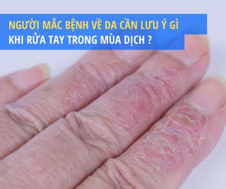 Người mắc bệnh về da cần lưu ý gì khi rửa tay trong mùa dịch Covid-19?
