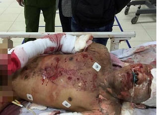 Nam sinh viên bị thương nặng sau tiếng nổ lớn