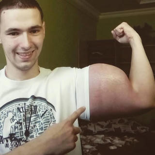 Tự tiêm dầu vào cơ bắp để tay to như... thủy thủ Popeye