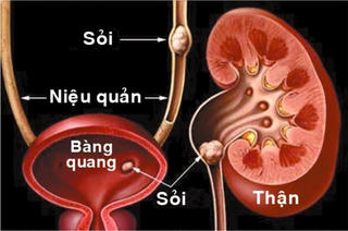 Phẫu thuật bóc đến 100 viên sỏi ở thận