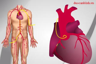 Cứu sống bệnh nhân bị viêm cơ tim cấp bằng kỹ thuật mới