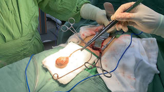 Cụ bà quên ống sonde 9 năm, viên sỏi to bằng quả trứng gà 