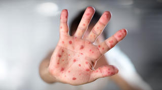 Tiêm hay không tiêm vaccine?