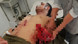 Sản xuất mìn đánh cá, người đàn ông bị đứt bàn tay