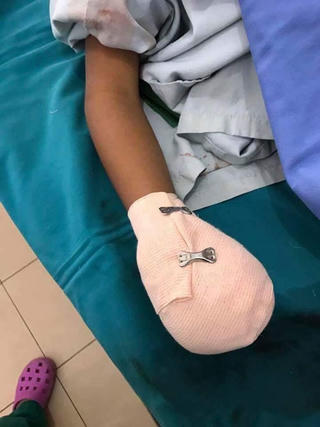 Pin điện thoại phát nổ khi sạc, một bé trai bị dập nát bàn tay