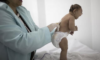 Mỹ khẳng định virus Zika gây chứng đầu nhỏ ở trẻ sơ sinh