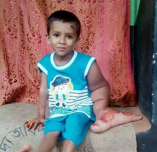 Cậu bé ‘tay voi’ bị cả làng xa lánh