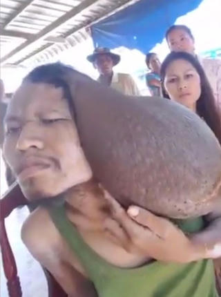 Người đàn ông 35 năm chung sống với khối u 'khủng'